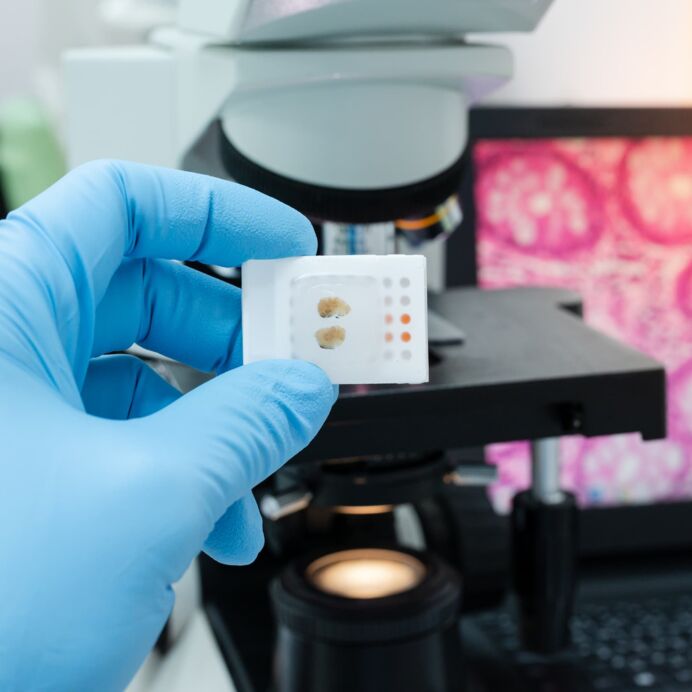Mikroskopische Untersuchung Ein Wissenschaftler trägt einen blauen Handschuh, der einen menschlichen Gewebeblock hält, und ein unscharfes modernes Mikroskop mit Digitalkamera und Computermonitor zeigt ein Drüsenbild.
